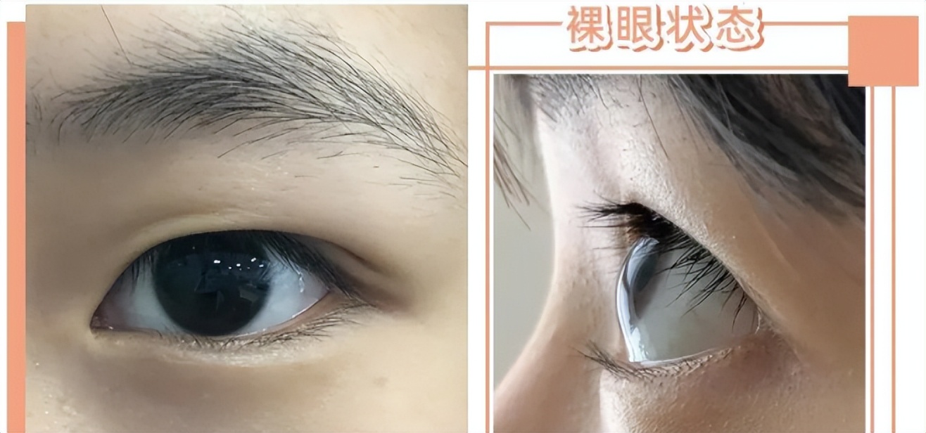 单眼皮肿眼泡早晨消肿,天生单眼皮肿眼泡消肿神器