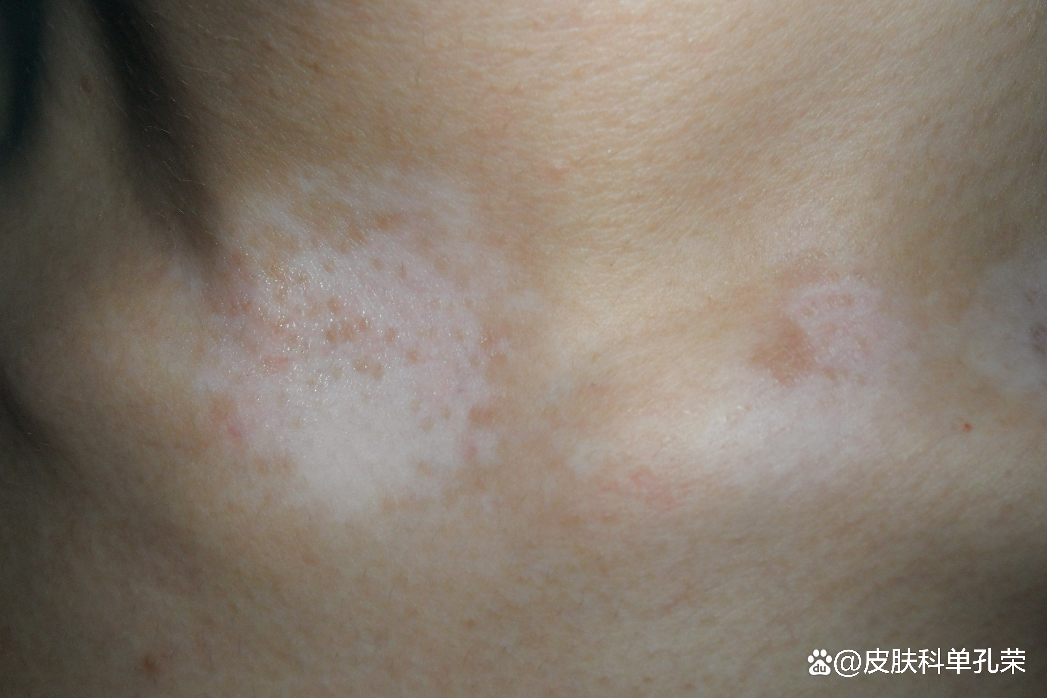 白斑发红发痒是什么原因,白斑痒了是意味着白斑发展了吗