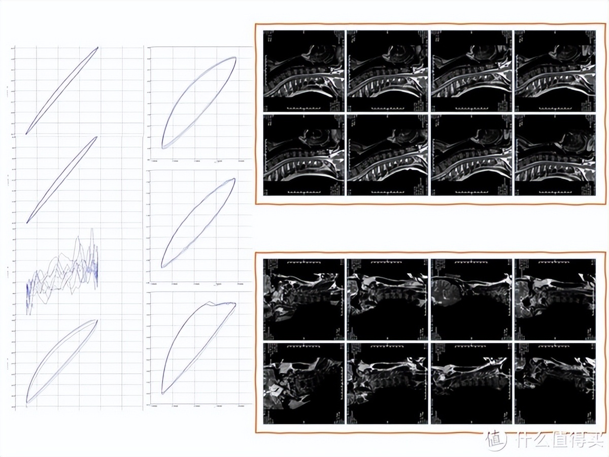 颈椎病睡记忆枕管用吗 (记忆枕对颈椎病有效)