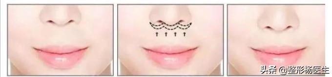 人中太长了好看吗,人中太长显老怎么办