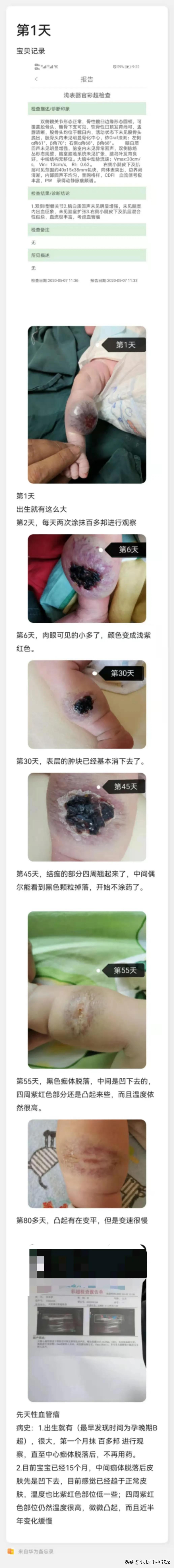 刚出生孩子肿瘤,刚出生长肿瘤