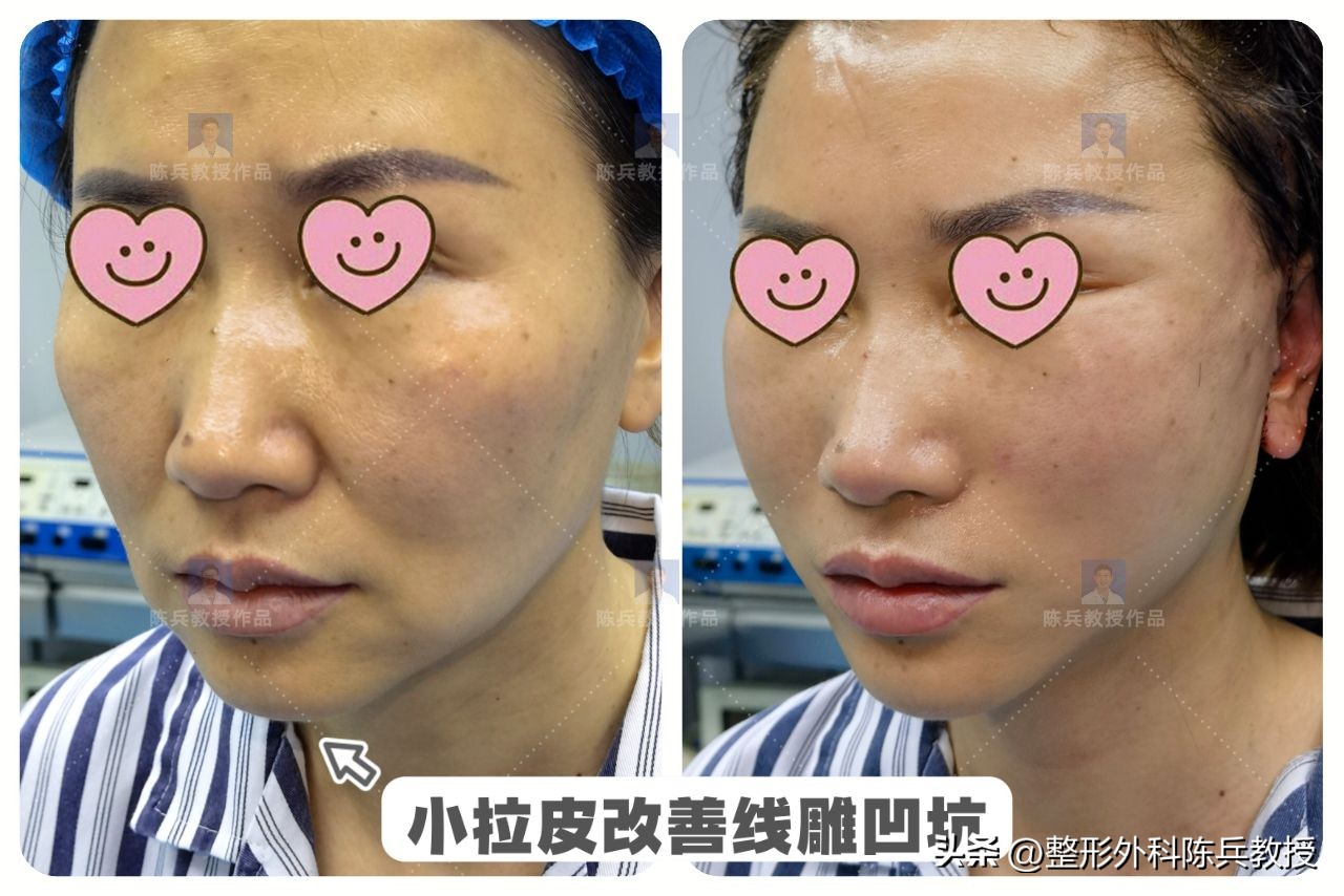 面部皮肤紧致可以做小拉皮吗,面部小拉皮效果怎么样