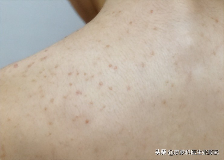 螨虫毛囊炎用什么药物治疗,毛囊炎用什么药治疗最好