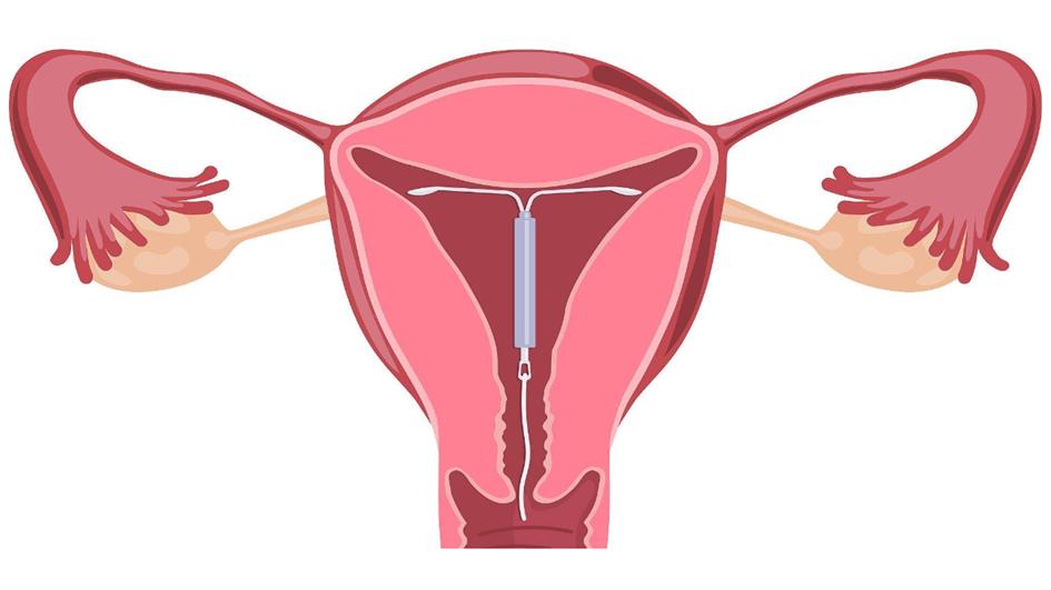 节育环更年期后是否要取出,节育环一直不取绝经后出血