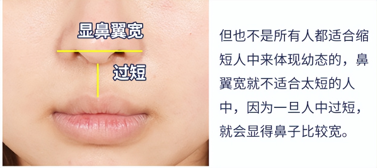 人中缩短修复,人中长显老怎么改善