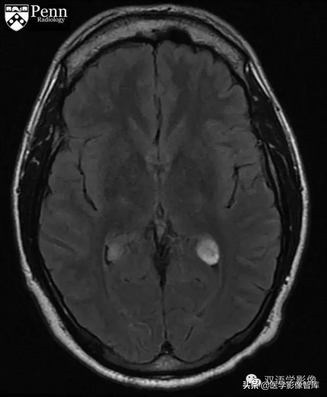 脉络丛黄色肉芽肿的进一步检查,脉络丛黄色肉芽肿有中成药吗