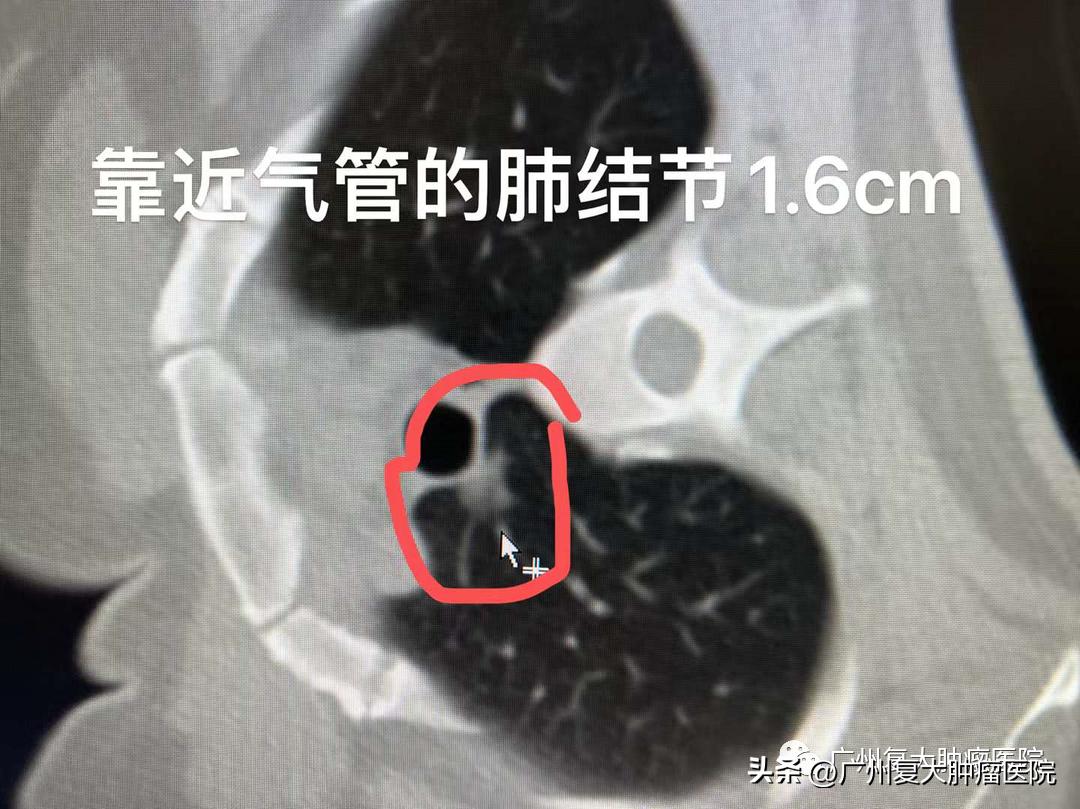 肺结节在内部如何切除,肺气管结节怎么治疗效果最好