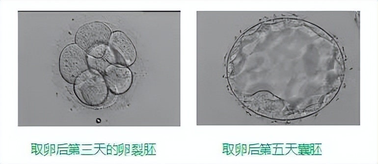 试管婴儿移植后需要躺着吗,试管婴儿移植之后怎么躺