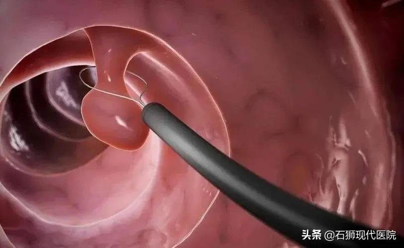 子宫长内膜息肉?这两种情况必须切除