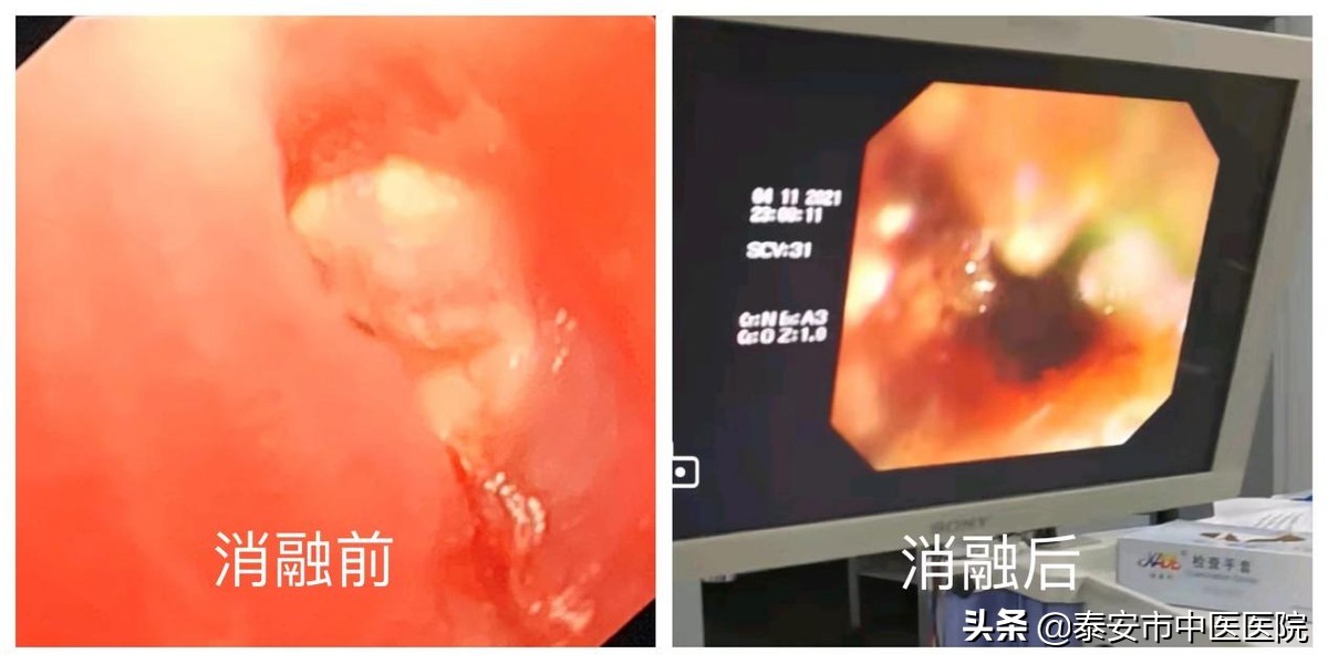 食管癌中段内镜下消融术,食管癌早期内镜下消融术