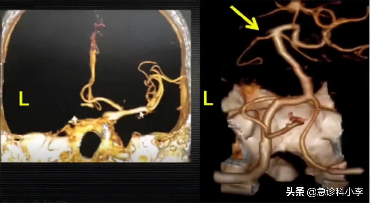 脑梗来临前腿脚先知,睡觉时出现5种迹象警惕脑梗信号