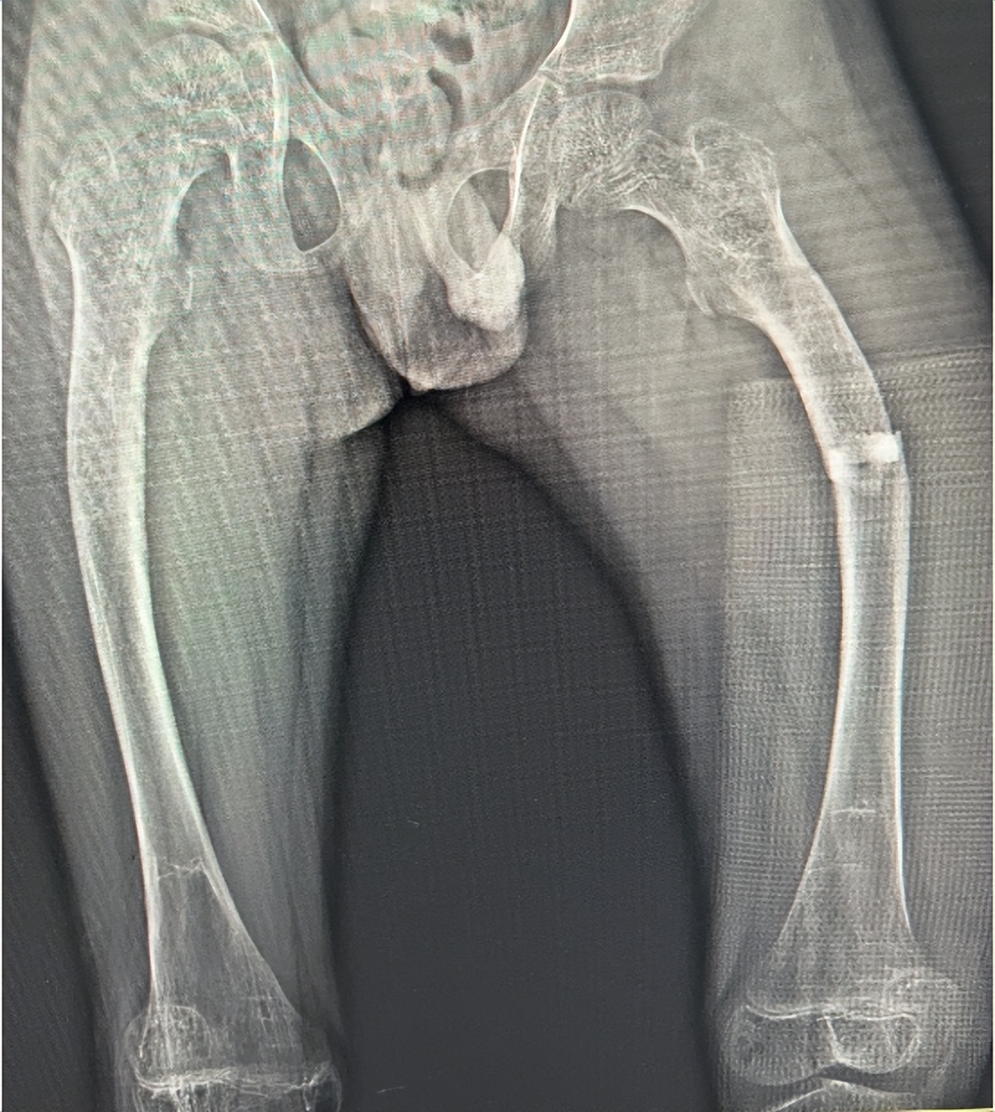 弹性髓内钉治疗儿童骨折,成骨不全可延长髓内钉