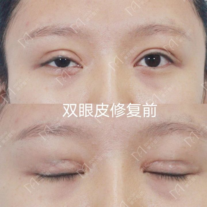 双眼皮太宽了能修复吗该怎么修复,双眼皮割窄了怎么修复宽