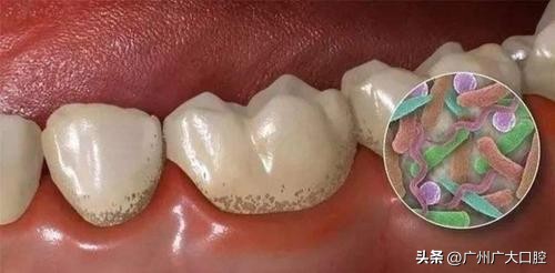 塞牙的食物不弄出来，牙齿可要遭老罪咯