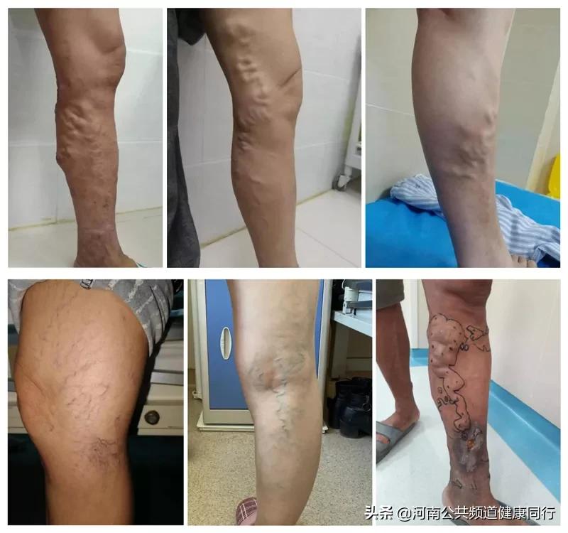 利用周末或者假期完成一个手术？河南省直三院血管外科推出“节假日无休，微创无瘢痕治疗下肢静脉曲张”