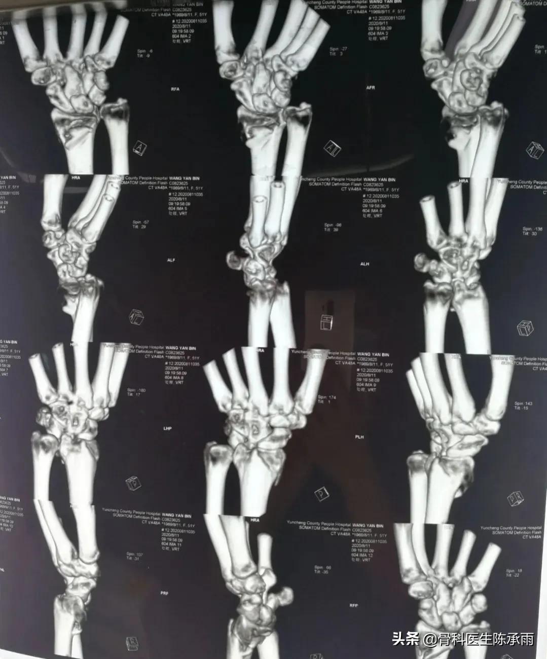 桡骨远端骨折累及关节面保守治疗,桡骨骨折保守还是手术