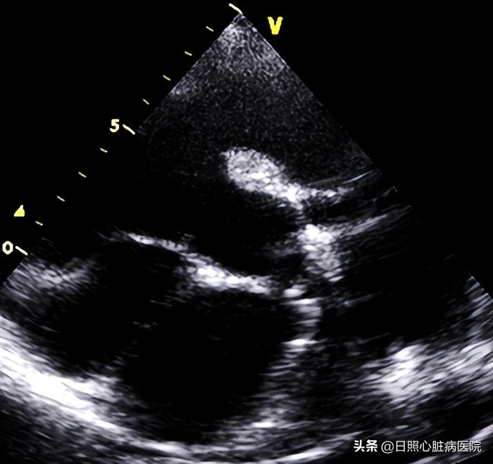 心脏室间隔缺损不治疗行吗,心脏有个洞要补吗