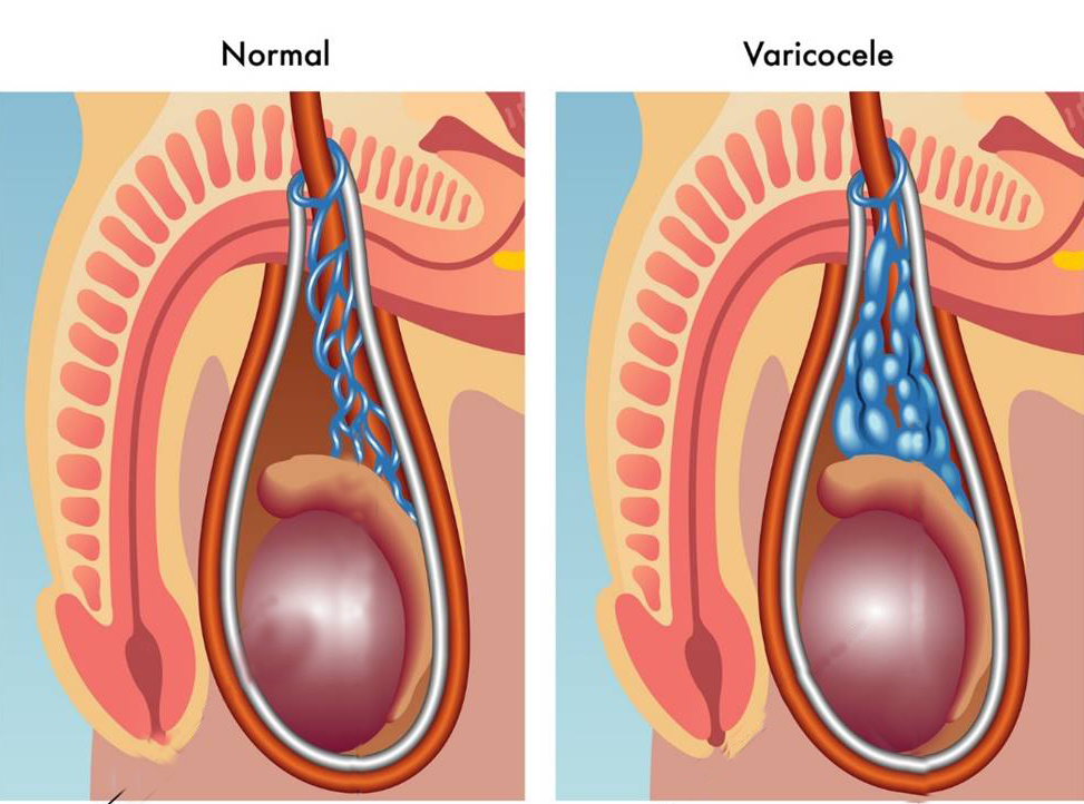 死精症是怎么回事,男人有死精症可以治好吗