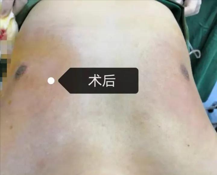 为什么男生的胸部很大,男生胸部大怎么办