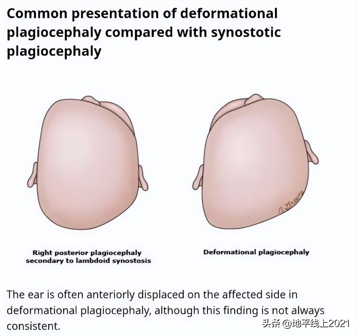 想让孩子有一个漂亮的头型，如何预防和治疗偏头与扁头？