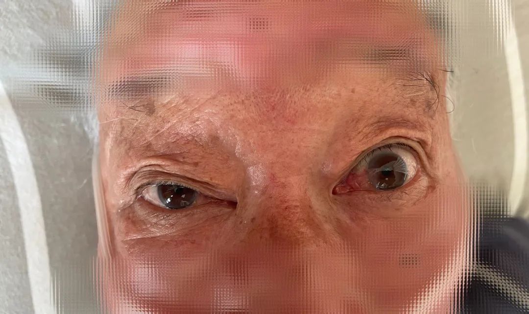 眼皮抬不起来吃什么药,眼皮抬不起来啥病