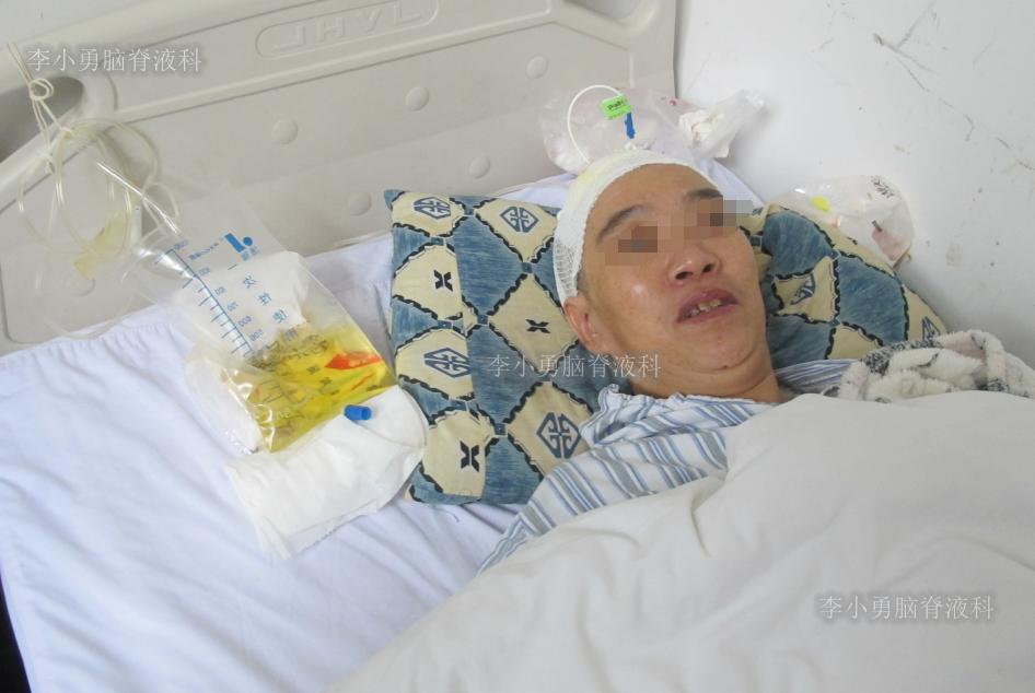 脑积水手术后4天还呕吐怎么回事,脑积水分流术后一直腹部疼痛