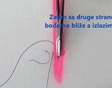 外科各种缝合方法的适用情况,外科操作缝合