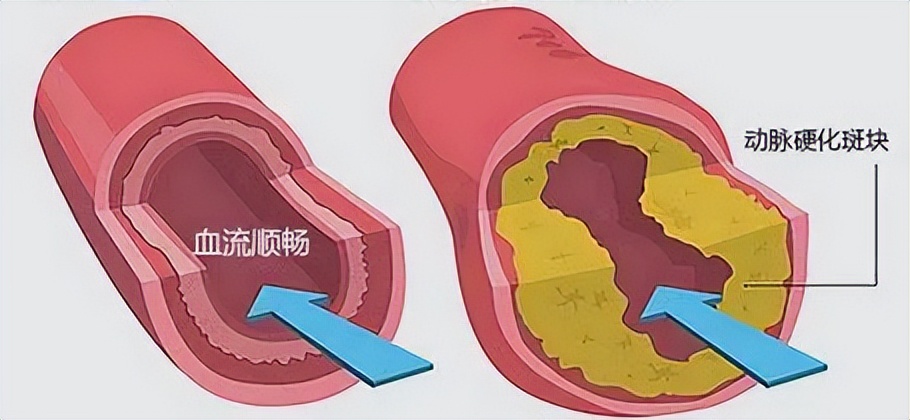 红酒软化血管靠谱吗,鱼油软化血管有效吗