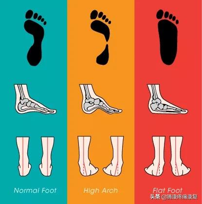 功能性高足弓的练习方式,用什么方法舒缓足弓疼痛