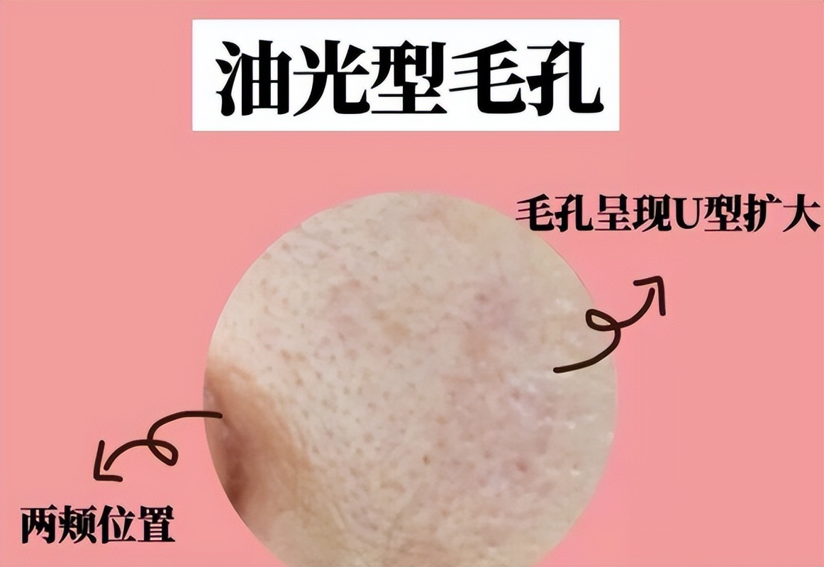 4种类型的毛孔粗大该怎么解决,怎样判断毛孔粗大的类型