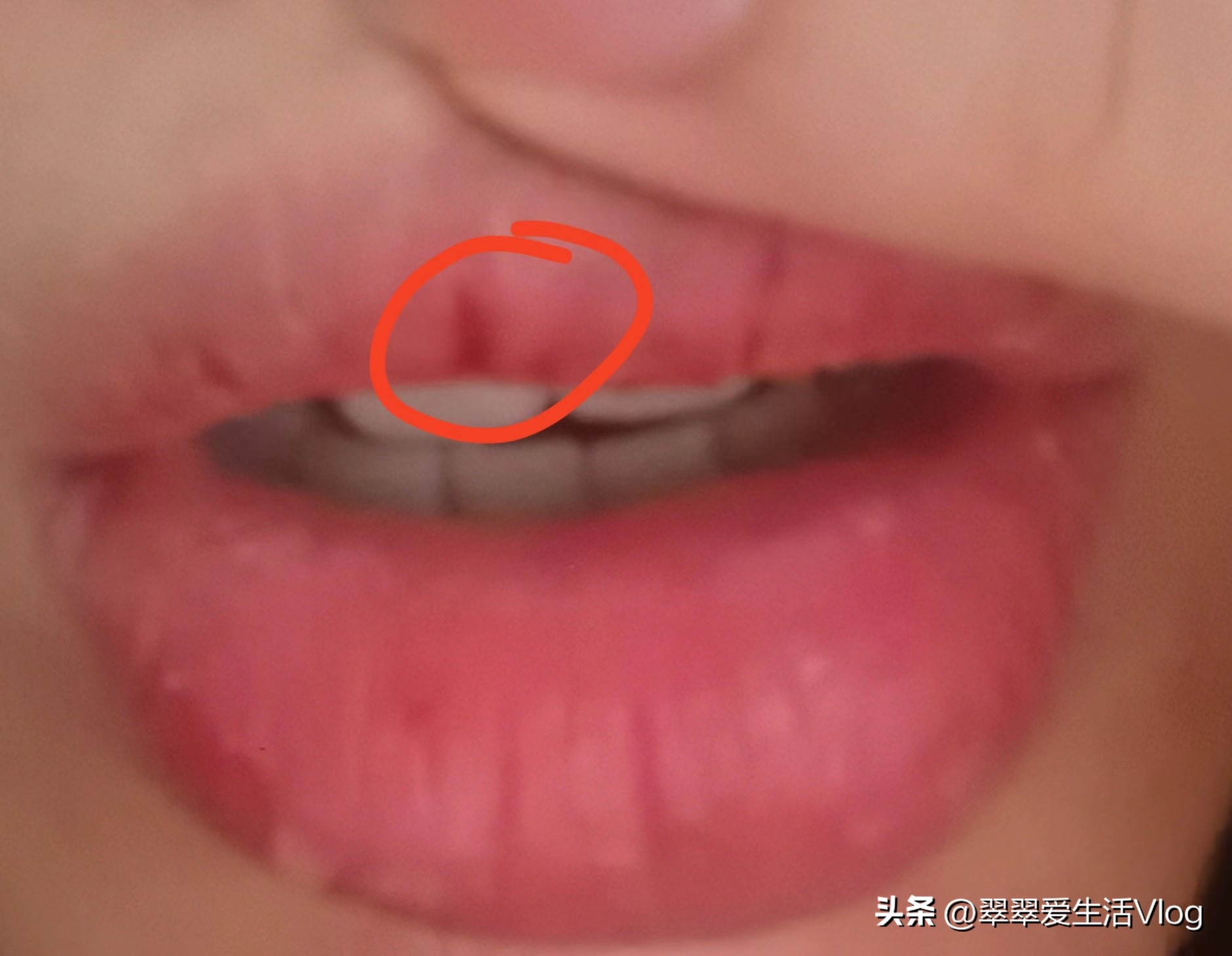 纹唇结痂自己撕了,纹唇结痂撕掉