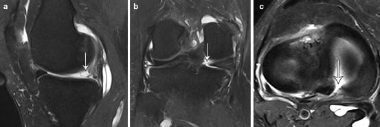 查半月板是拍片还是磁共振,半月板核磁共振影像诊断