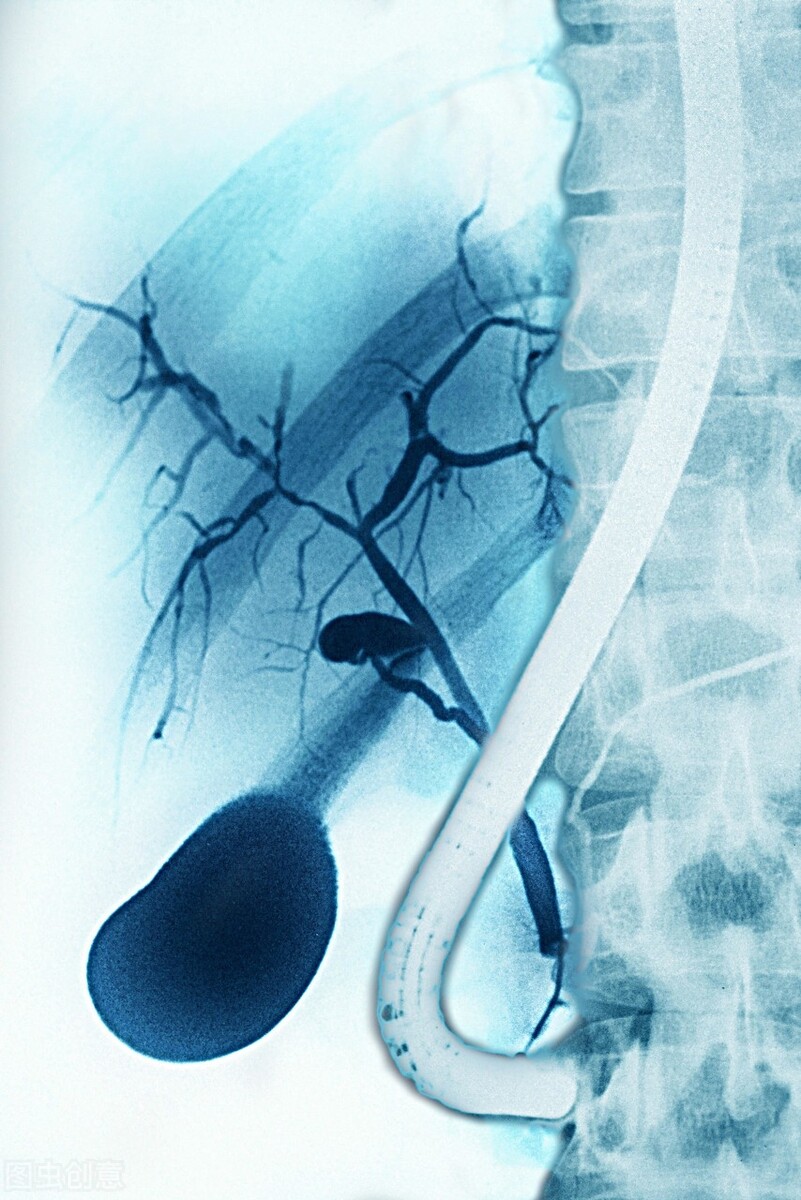 化脓性梗阻性胆管炎常见的病因是,化脓性胆管炎的病理原因