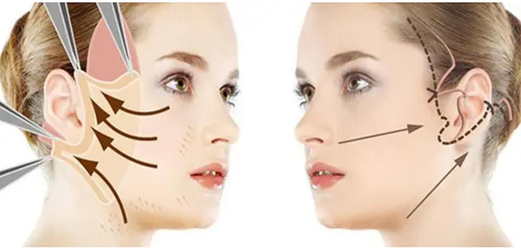 做个面部拉皮手术要多少钱啊,小拉皮手术后多久能恢复自然
