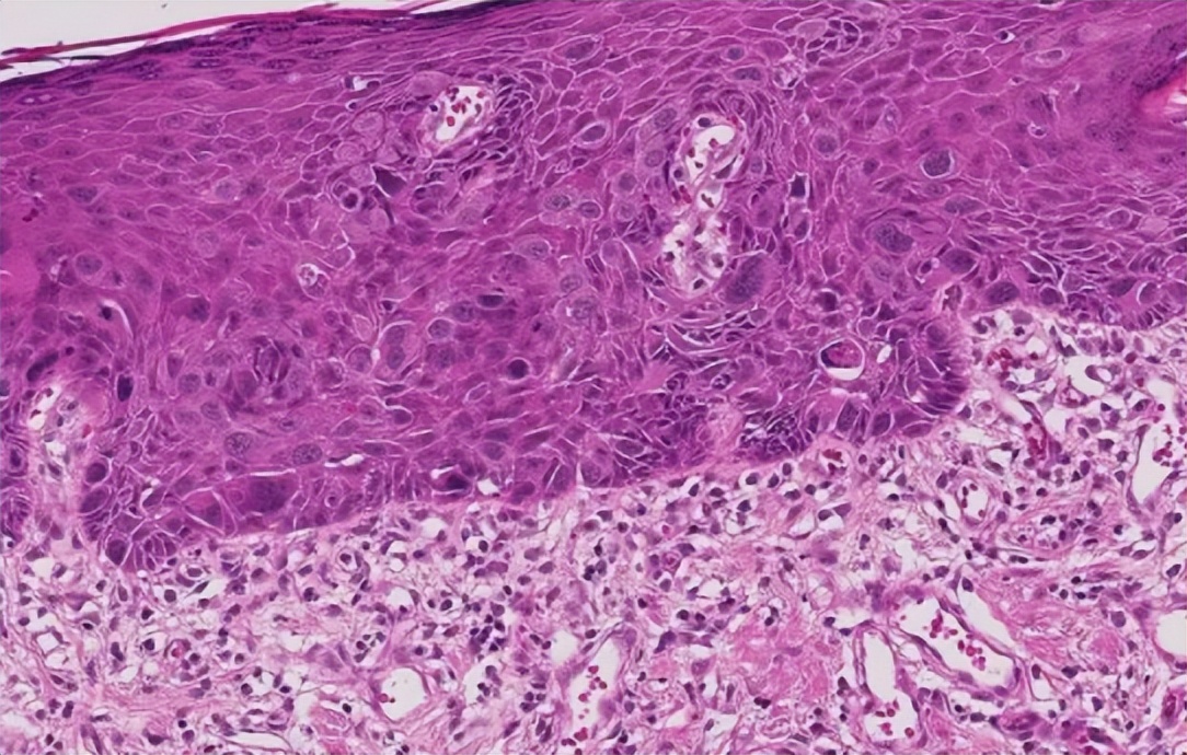 女性出汗引起的胸部痒,胸部老是出汗和痒是什么情况