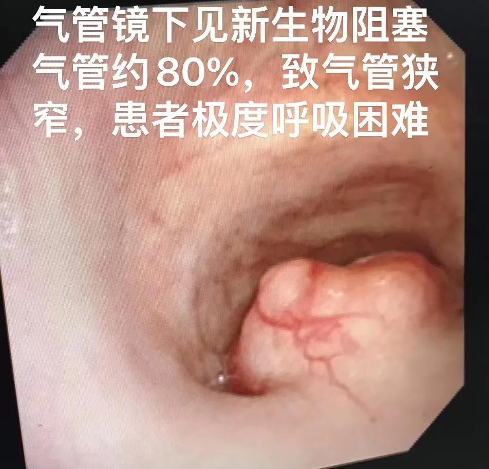 上气道狭窄治疗,气道狭窄致命吗