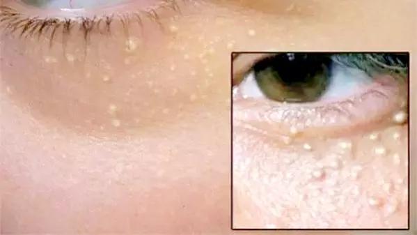 挤不出东西的脂肪粒怎么去掉,鼻子脂肪粒挤不出来还挤吗