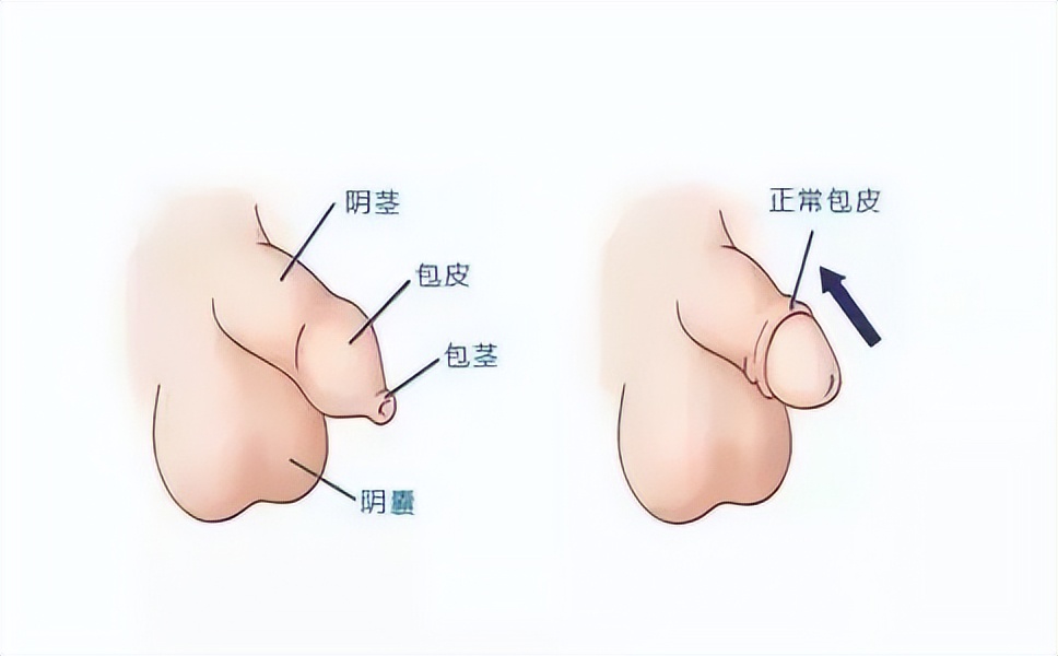 扬州割包皮多长时间出院,割包皮当天回家么
