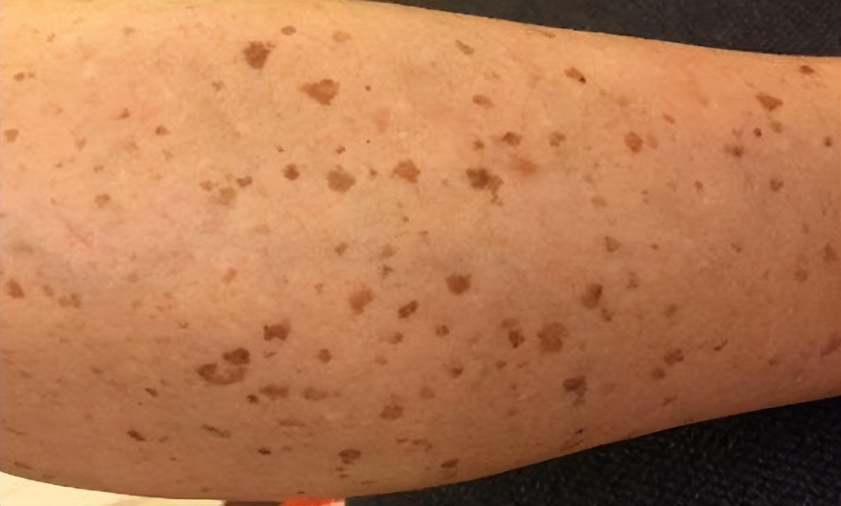 老人斑红霉素可以擦吗,老人斑抹红霉素软膏