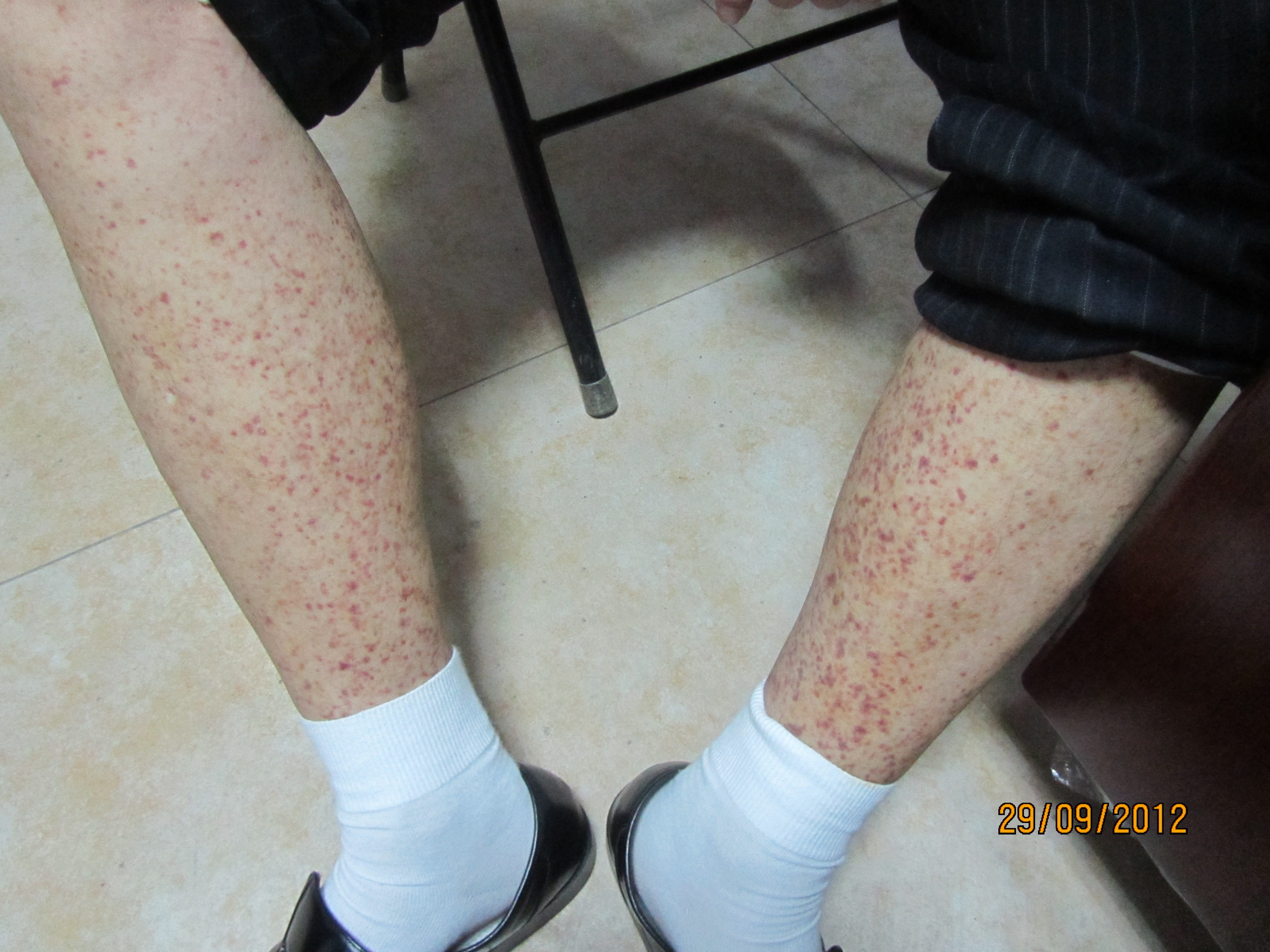 过敏性紫癜小腿反复出现出血点,过敏性紫癜老反复起小红点怎么办