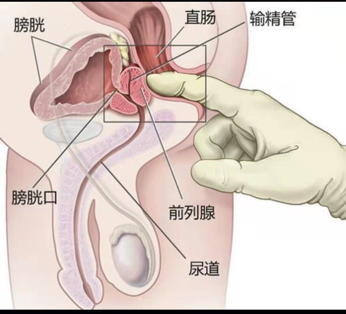 前列腺常规检查报告单正常,前列腺核磁共振报告单怎么解读