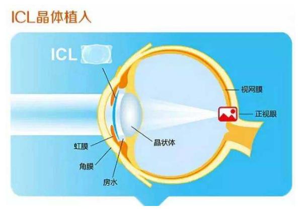超高度近视怎么防止视力继续下降,超高度近视会有什么症状
