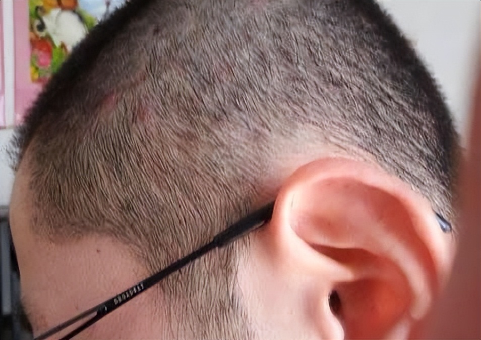 头皮老是长疙瘩和脓包是怎么了,头皮老是长疙瘩有脓包是什么原因