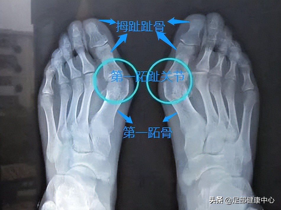 常见大拇趾疼痛原因,女性脚趾拇疼痛预示十种疾病