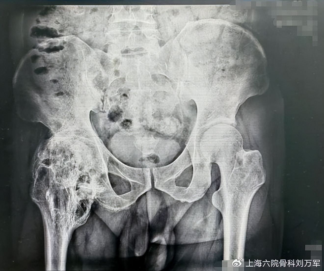 关节被“焊死”，在上海六院终于“重获自由”