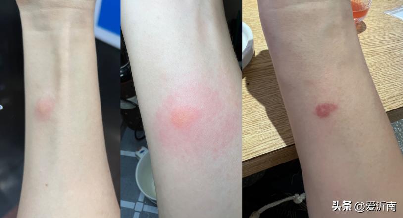 身上突然痒是蚊子吗,身上无缘无故的痒到处长蚊子大包