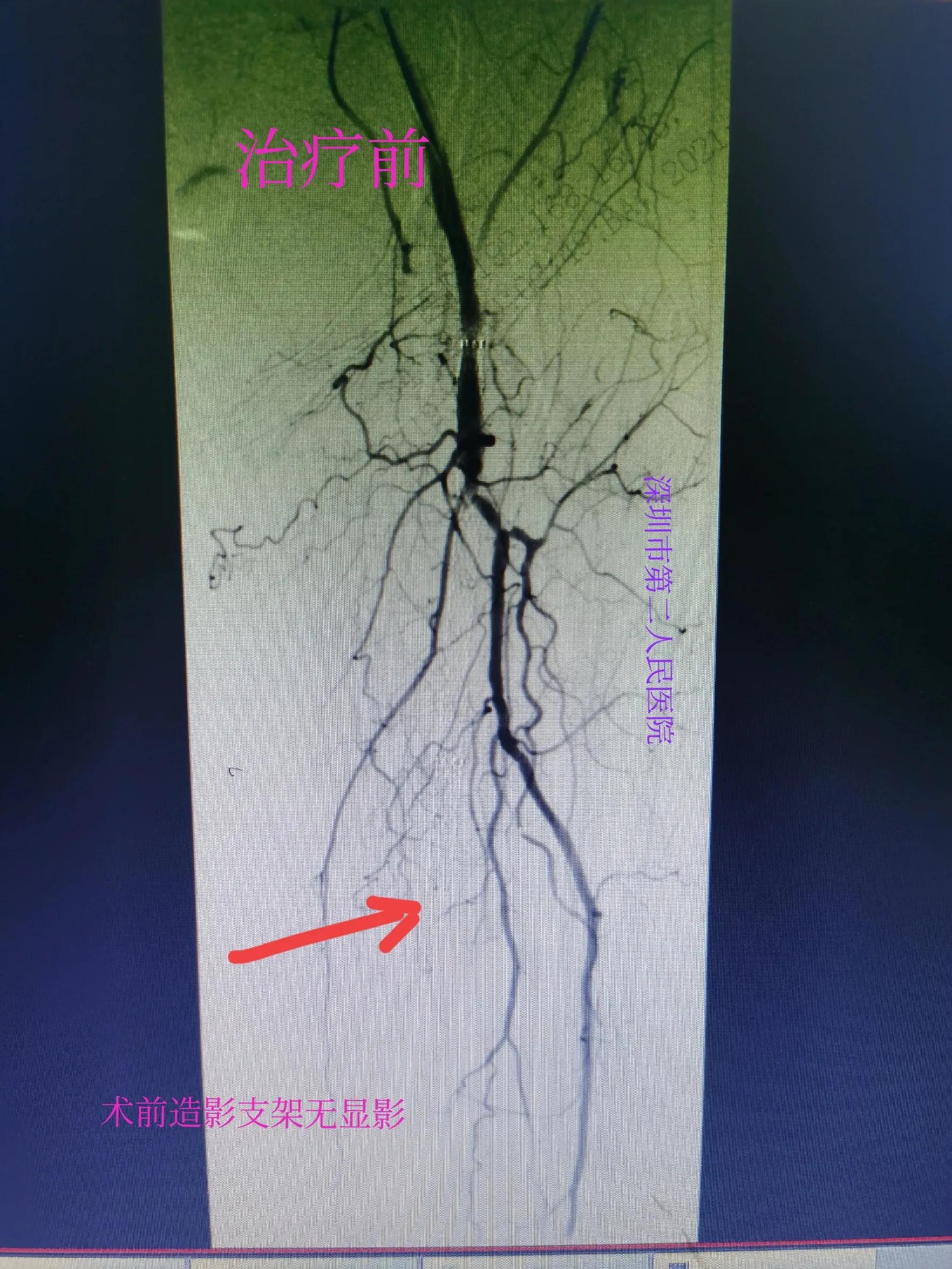 老年人小腿浮肿发紫什么原因,老人突然小腿发凉发软
