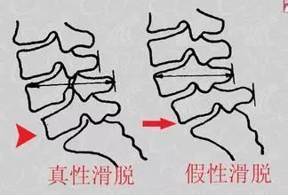腰椎间盘突出吃了草药反而更疼,腰椎间盘突出煎熬