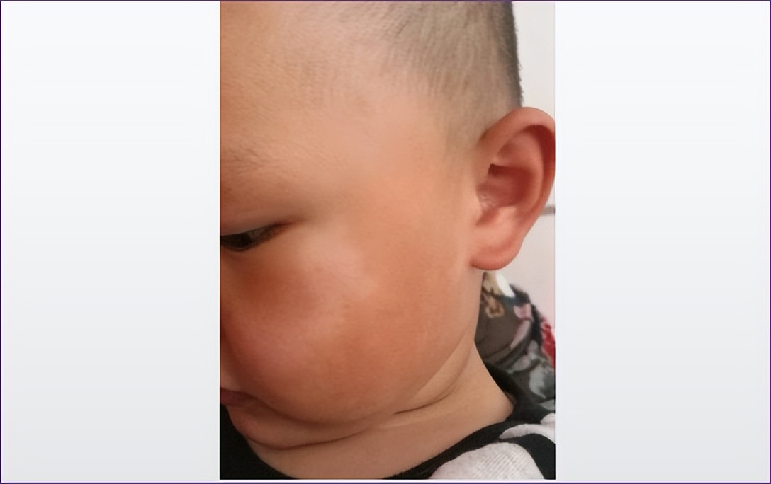 宝宝指甲有白斑是肚子有虫吗,一周半宝宝指甲上有白点怎么回事