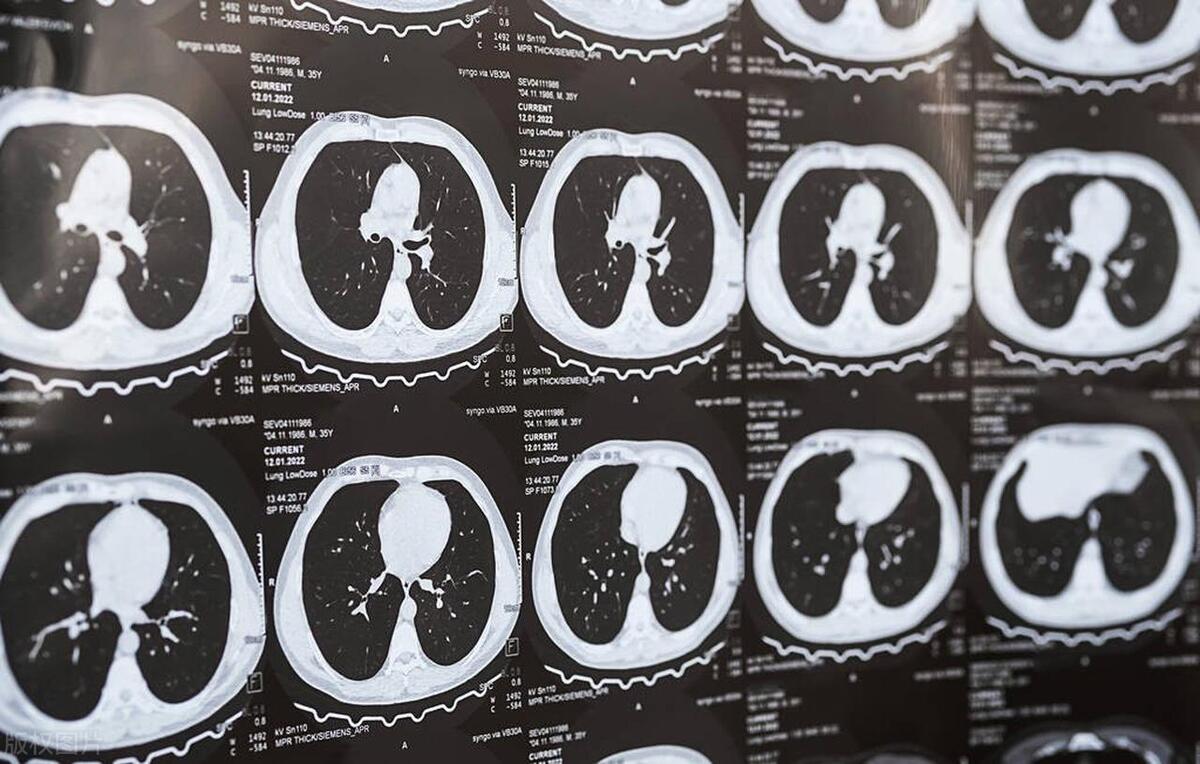 原位癌不变化要不要手术,原位癌不属于重疾吗